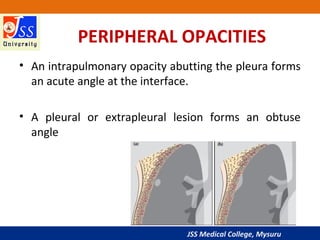 JSS Medical College, Mysuru
PERIPHERAL OPACITIES
• An intrapulmonary opacity abutting the pleura forms
an acute angle at the interface.
• A pleural or extrapleural lesion forms an obtuse
angle
 