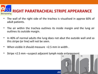 JSS Medical College, Mysuru
RIGHT PARATRACHEAL STRIPE APPEARANCE
• The wall of the right side of the trachea is visualised in approx 60% of
adult patients.
• The air within the trachea outlines its inside margin and the lung air
outlines its outside margin.
• In 40% of normal adults the lung does not abut the outside wall and so
this stripe (or line) will not be seen.
• When visible it should measure <2.5 mm in width .
• Stripe >2.5 mm –suspect adjacent lymph node enlargement
 
