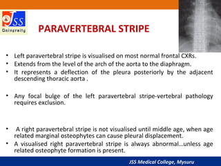JSS Medical College, Mysuru
PARAVERTEBRAL STRIPE
• Left paravertebral stripe is visualised on most normal frontal CXRs.
• Extends from the level of the arch of the aorta to the diaphragm.
• It represents a deflection of the pleura posteriorly by the adjacent
descending thoracic aorta .
• Any focal bulge of the left paravertebral stripe-vertebral pathology
requires exclusion.
• A right paravertebral stripe is not visualised until middle age, when age
related marginal osteophytes can cause pleural displacement.
• A visualised right paravertebral stripe is always abnormal…unless age
related osteophyte formation is present.
 