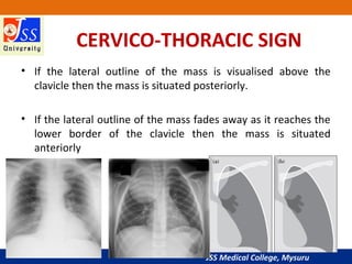 JSS Medical College, Mysuru
CERVICO-THORACIC SIGN
• If the lateral outline of the mass is visualised above the
clavicle then the mass is situated posteriorly.
• If the lateral outline of the mass fades away as it reaches the
lower border of the clavicle then the mass is situated
anteriorly
 