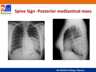 JSS Medical College, Mysuru
Spine Sign -Posterior mediastinal mass
 