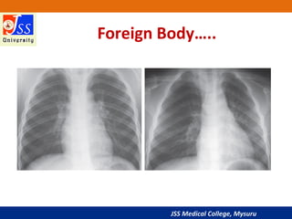JSS Medical College, Mysuru
Foreign Body…..
 