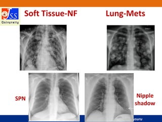 JSS Medical College, Mysuru
Soft Tissue-NF Lung-Mets
Nipple
shadow
SPN
 