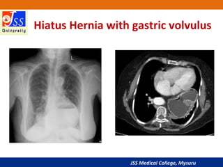 JSS Medical College, Mysuru
Hiatus Hernia with gastric volvulus
 