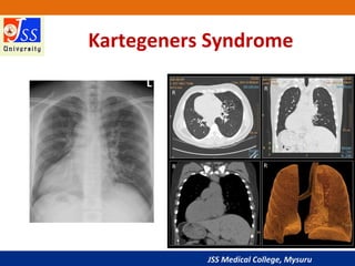 JSS Medical College, Mysuru
Kartegeners Syndrome
 