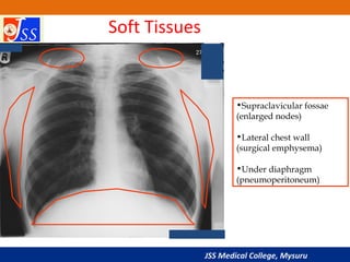 JSS Medical College, Mysuru
•Supraclavicular fossae
(enlarged nodes)
•Lateral chest wall
(surgical emphysema)
•Under diaph...