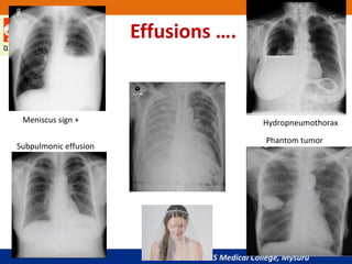 JSS Medical College, Mysuru
Effusions ….
Meniscus sign +
Subpulmonic effusion
Hydropneumothorax
Phantom tumor
 