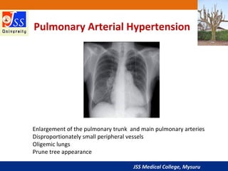 JSS Medical College, Mysuru
Pulmonary Arterial Hypertension
Enlargement of the pulmonary trunk and main pulmonary arteries...
