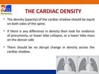 JSS Medical College, Mysuru
THE CARDIAC DENSITY
• The density (opacity) of the cardiac shadow should be equal
on both side...