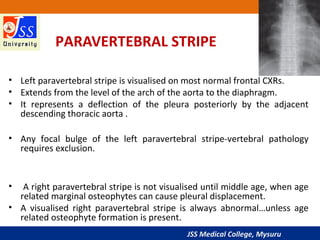 JSS Medical College, Mysuru
PARAVERTEBRAL STRIPE
• Left paravertebral stripe is visualised on most normal frontal CXRs.
• ...