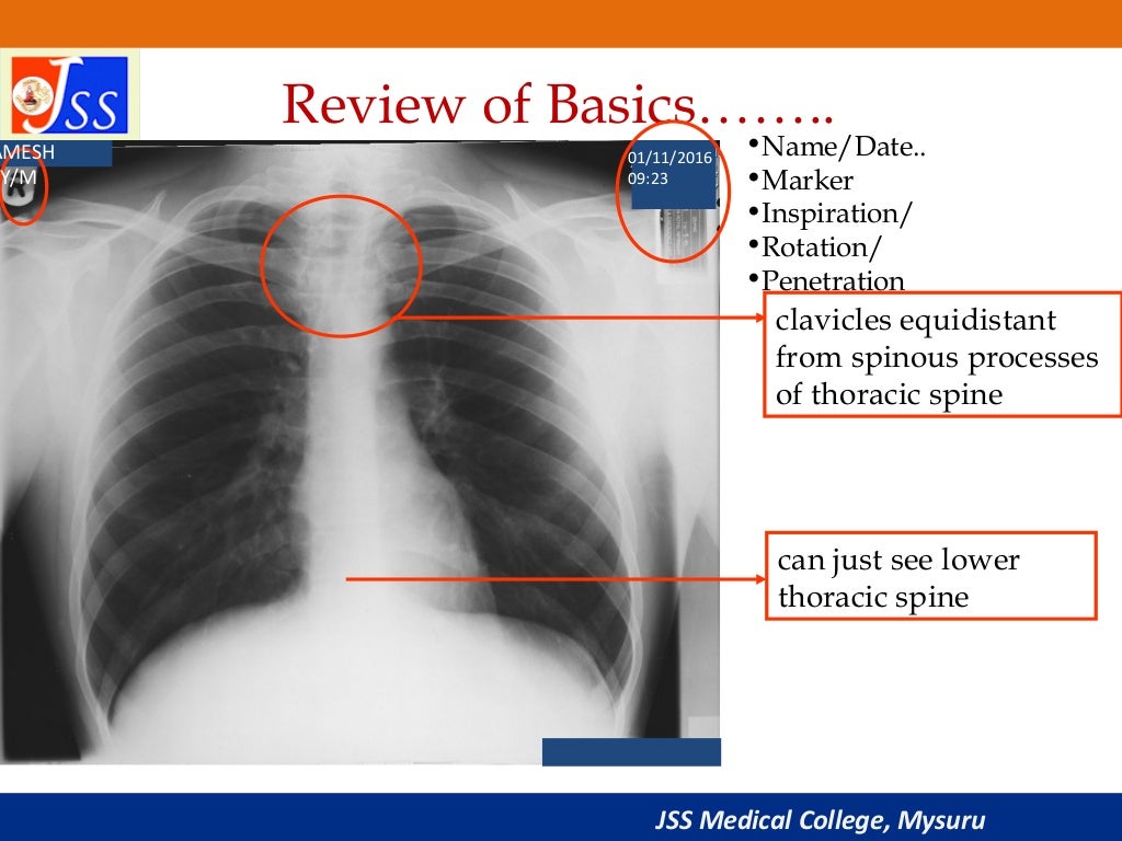 Approach to Chest XRay and Interpretation