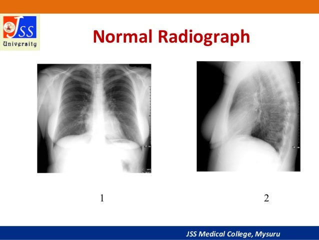 Approach To Chest X Ray And Interpretation