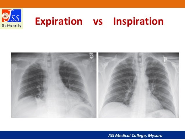 Approach To Chest X Ray And Interpretation approach-to-chest-x-ray-and-interpretation
