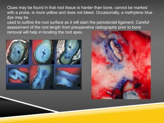 Clues may be found in that root tissue is harder than bone, cannot be marked
with a probe, is more yellow and does not bleed. Occasionally, a methylene blue
dye may be
used to outline the root surface as it will stain the periodontal ligament. Careful
assessment of the root length from preoperative radiographs prior to bone
removal will help in locating the root apex.
 