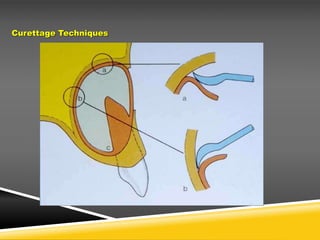 Curettage Techniques
 