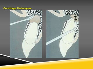 Curettage Techniques
 