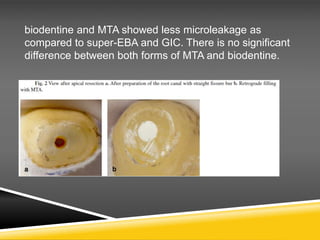 biodentine and MTA showed less microleakage as
compared to super-EBA and GIC. There is no significant
difference between both forms of MTA and biodentine.
 