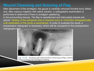 Wound Cleansing and Suturing of Flap.
After placement of the amalgam, the gauze is carefully removed fromthe bony defect
and, after copious irrigation with saline solution, a radiographic examination is
performed to determine if there is amalgam splattering
in the surrounding tissues. The flap is repositioned and interrupted sutures are
placed. Healing of the periapical area is checked every 6–12months radiographically,
until ossification of the cavity is ascertained. In order to evaluate the result, a
preoperative radiograph is necessary, which will be compared to the postoperative
radiographs later
 