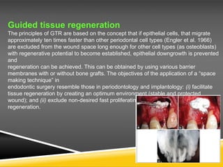 Guided tissue regeneration
The principles of GTR are based on the concept that if epithelial cells, that migrate
approximately ten times faster than other periodontal cell types (Engler et al. 1966)
are excluded from the wound space long enough for other cell types (as osteoblasts)
with regenerative potential to become established, epithelial downgrowth is prevented
and
regeneration can be achieved. This can be obtained by using various barrier
membranes with or without bone grafts. The objectives of the application of a “space
making technique” in
endodontic surgery resemble those in periodontology and implantology: (i) facilitate
tissue regeneration by creating an optimum environment (stable and protected
wound); and (ii) exclude non-desired fast proliferating cells from interfering with tissue
regeneration.
 