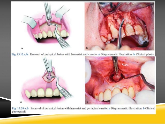 apicoectomy