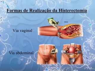 Formas de Realização da Histerectomia
Via vaginal
Via abdominal
 