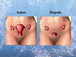 Antes Depois
 