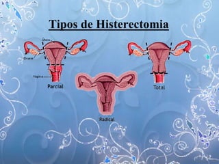 Tipos de Histerectomia
 