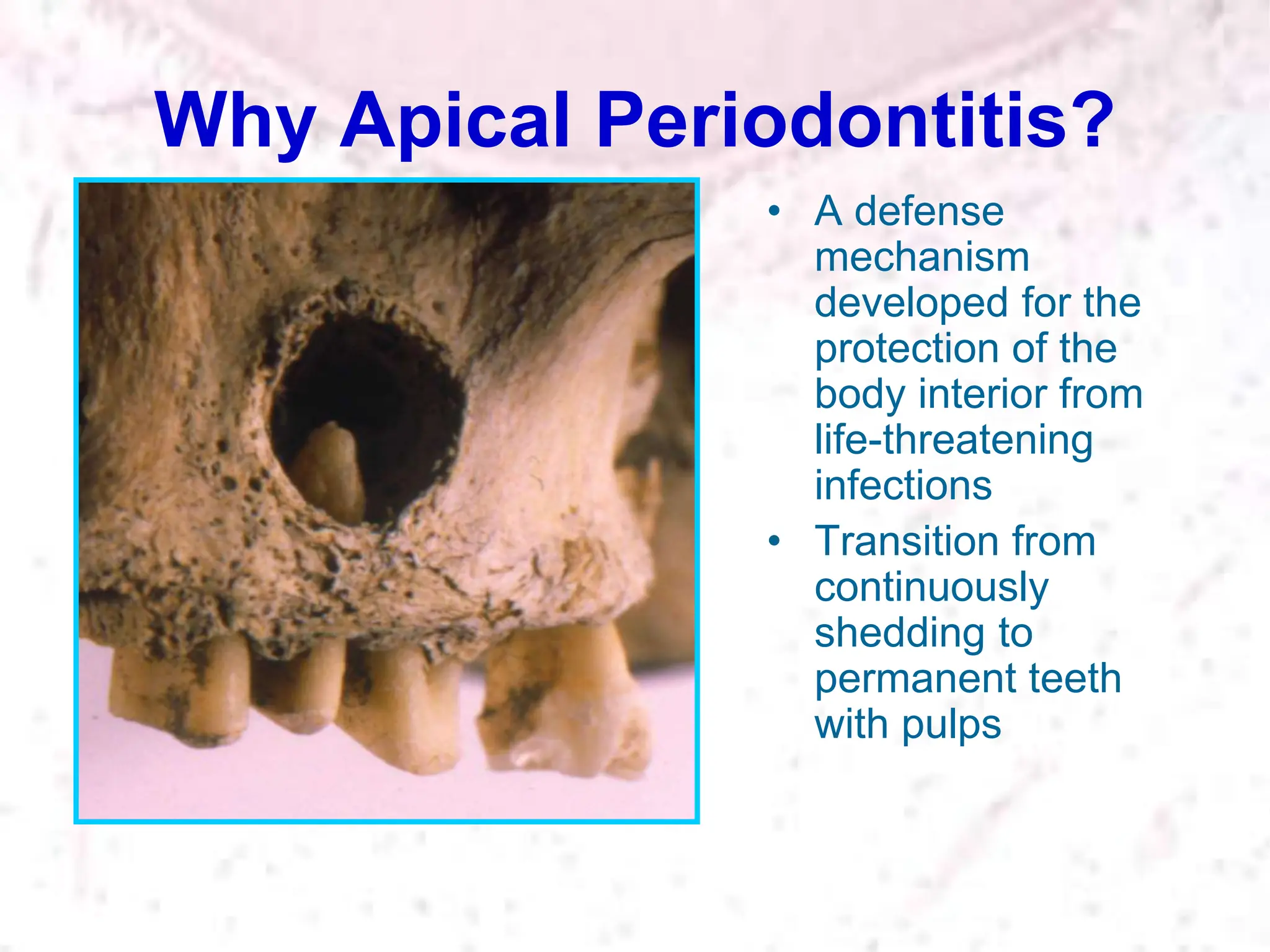 Why Apical Periodontitis?
• A defense
mechanism
developed for the
protection of the
body interior from
life-threatening
infections
• Transition from
continuously
shedding to
permanent teeth
with pulps
 