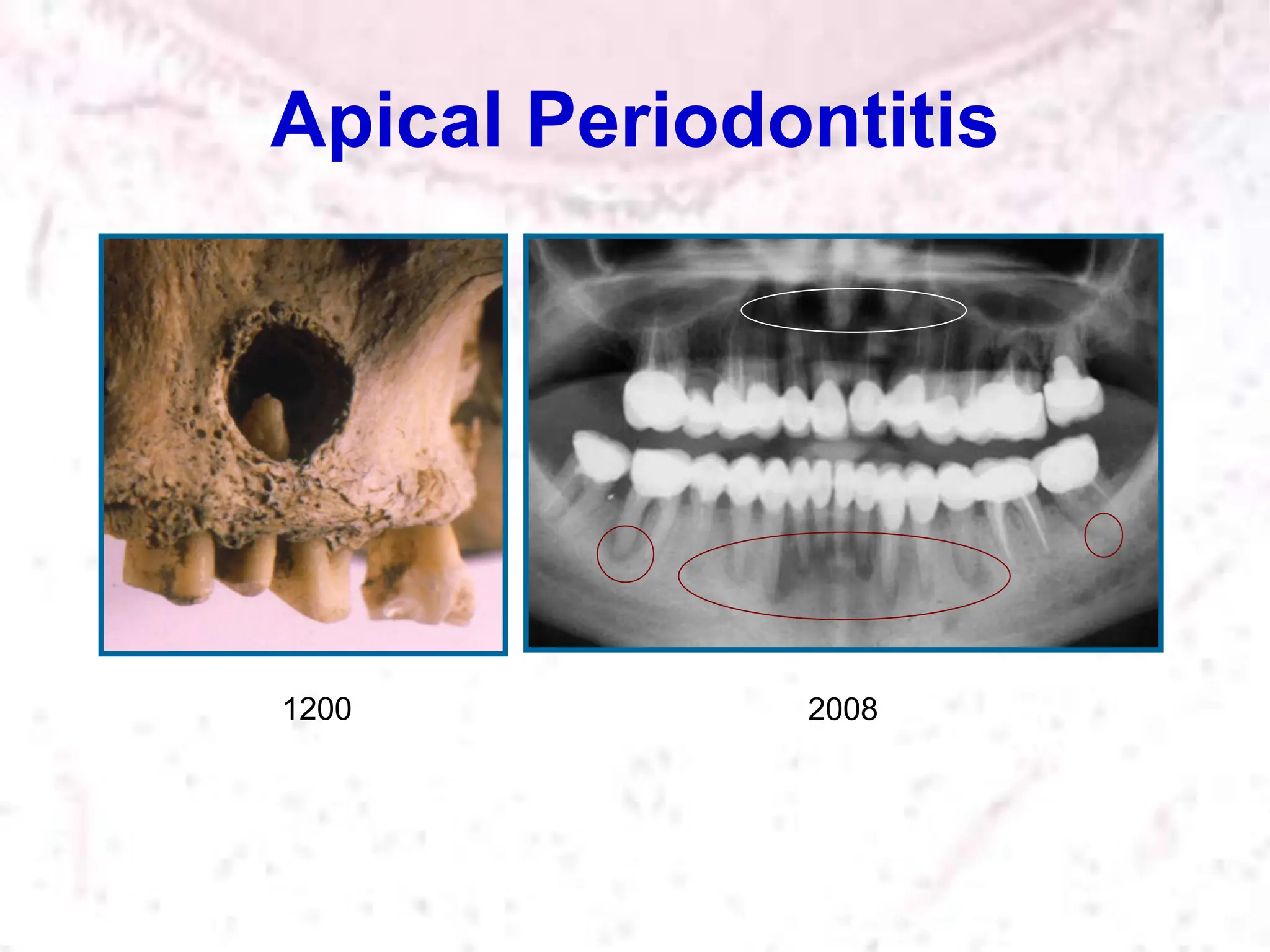 Apical Periodontitis
2008
1200
 