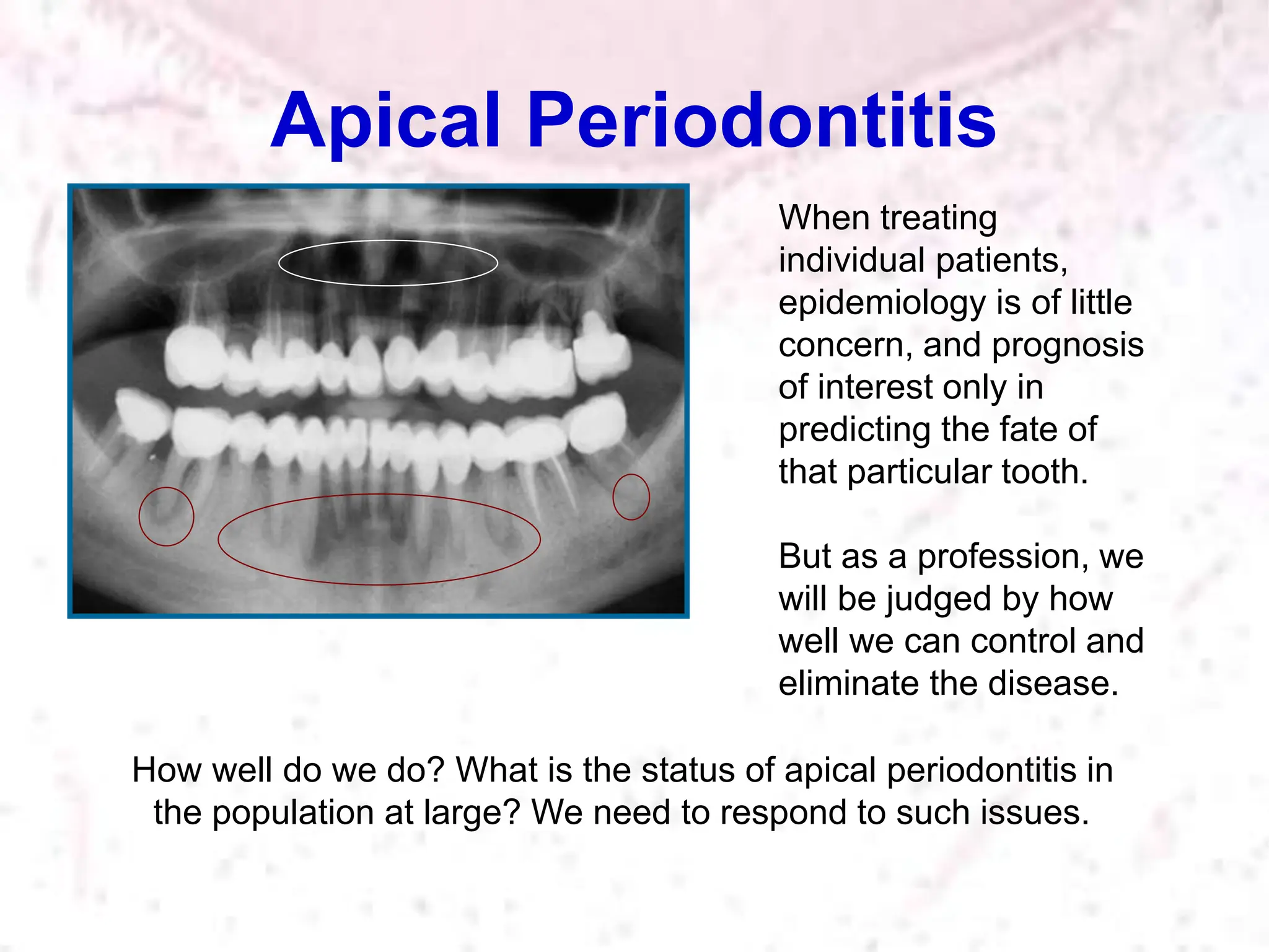 Apical Periodontitis
How well do we do? What is the status of apical periodontitis in
the population at large? We need to respond to such issues.
When treating
individual patients,
epidemiology is of little
concern, and prognosis
of interest only in
predicting the fate of
that particular tooth.
But as a profession, we
will be judged by how
well we can control and
eliminate the disease.
 
