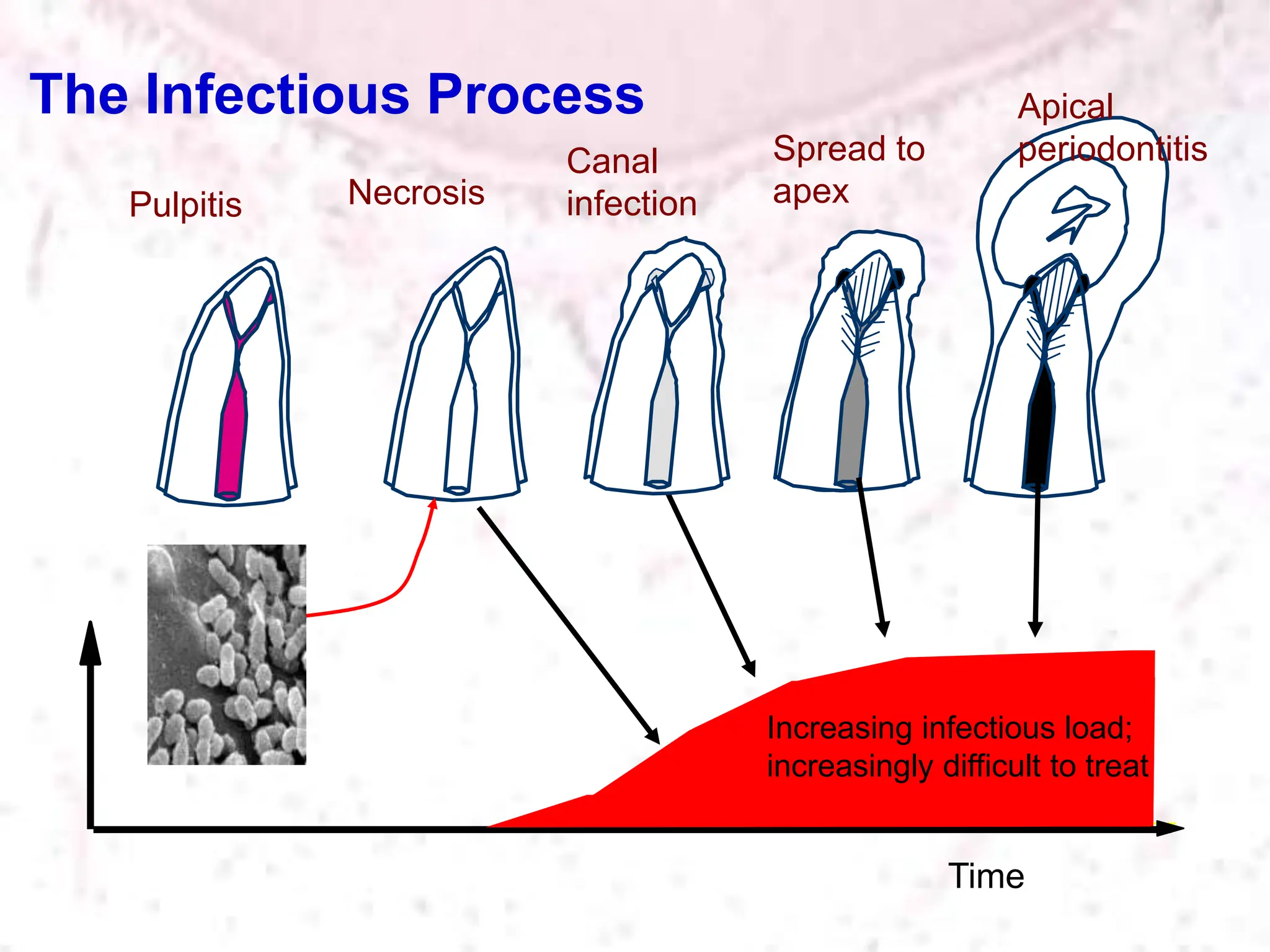 The Infectious Process
Pulpitis Necrosis
Canal
infection
Apical
periodontitis
Time
Spread to
apex
Increasing infectious load;
increasingly difficult to treat
 