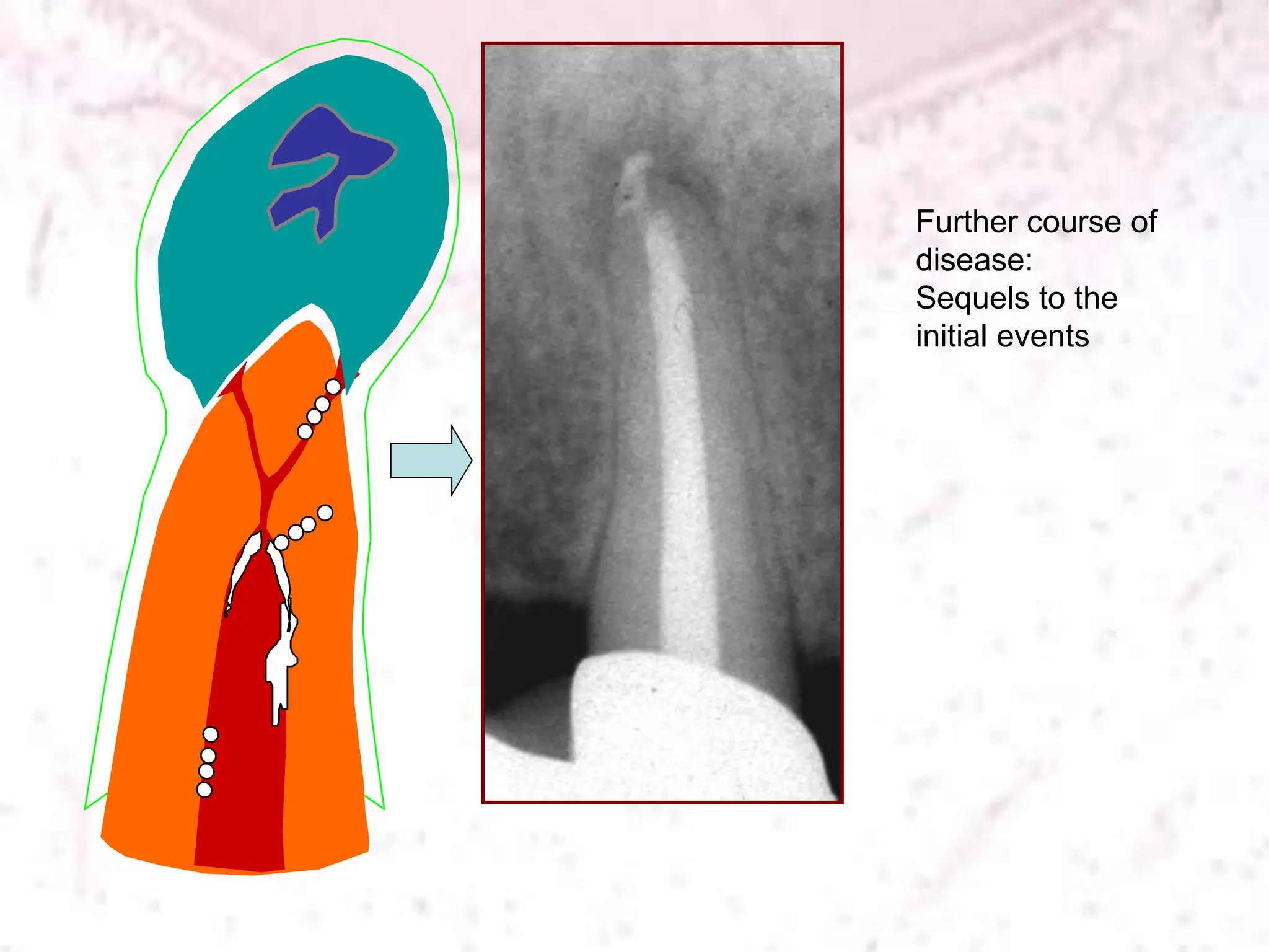 Further course of
disease:
Sequels to the
initial events
 
