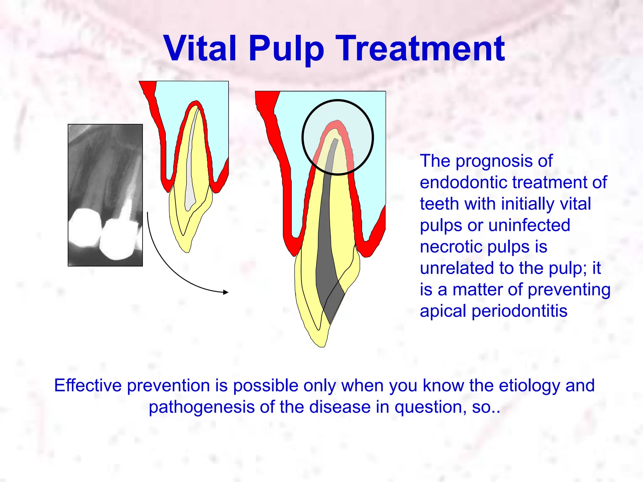 Effective prevention is possible only when you know the etiology and
pathogenesis of the disease in question, so..
Vital Pulp Treatment
The prognosis of
endodontic treatment of
teeth with initially vital
pulps or uninfected
necrotic pulps is
unrelated to the pulp; it
is a matter of preventing
apical periodontitis
 