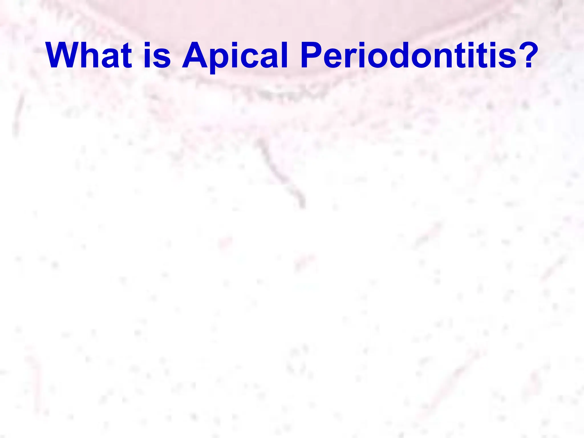 What is Apical Periodontitis?
 