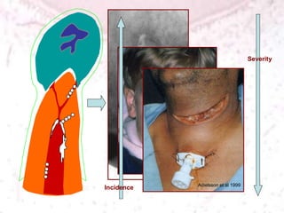Severity
Incidence Adielsson et al 1999
 