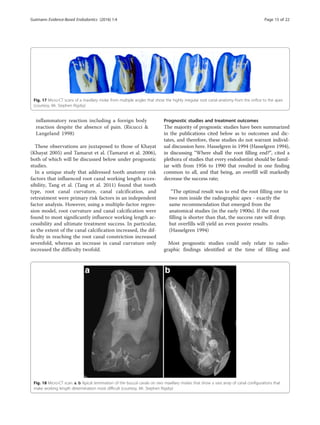 Apical termination of root canal | PDF