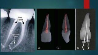 APICAL THIRD PPT.pptx