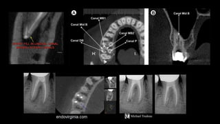 APICAL THIRD PPT.pptx