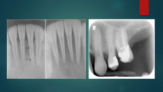 APICAL THIRD PPT.pptx