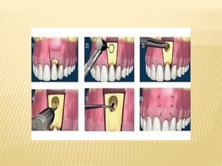 Comprehensive Guide to Apicoectomy: Indications, Techniques, and ...