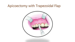 Apicoectomy with Trapezoidal Flap
 