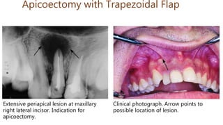 Extensive periapical lesion at maxillary
right lateral incisor. Indication for
apicoectomy.
Apicoectomy with Trapezoidal Flap
Clinical photograph. Arrow points to
possible location of lesion.
 