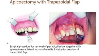 Surgical procedure for removal of periapical lesion, together with
apicoectomy at lateral incisor of maxilla. Incision for creation of
trapezoidal flap.
Apicoectomy with Trapezoidal Flap
 