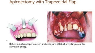 Apicoectomy with Trapezoidal Flap
Reflection of mucoperiosteum and exposure of labial alveolar plate after
elevation of flap.
 