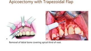 Apicoectomy with Trapezoidal Flap
Removal of labial bone covering apical third of root.
 