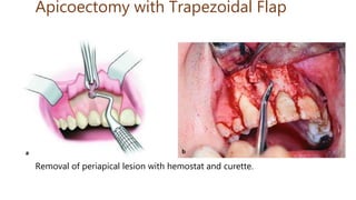 Apicoectomy with Trapezoidal Flap
Removal of periapical lesion with hemostat and curette.
 