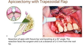 Apicoectomy with Trapezoidal Flap
Resection of apex with fissure bur and beveling at a 45° angle. The
resection faces the surgeon and is at a distance of 2–3 mm from the root
tip.
 