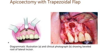 Apicoectomy with Trapezoidal Flap
Diagrammatic illustration (a) and clinical photograph (b) showing beveled
root of lateral incisor.
 