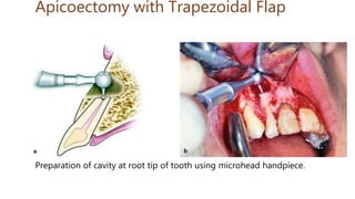 Apicoectomy with Trapezoidal Flap
Preparation of cavity at root tip of tooth using microhead handpiece.
 