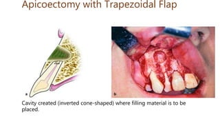 Apicoectomy with Trapezoidal Flap
Cavity created (inverted cone-shaped) where filling material is to be
placed.
 